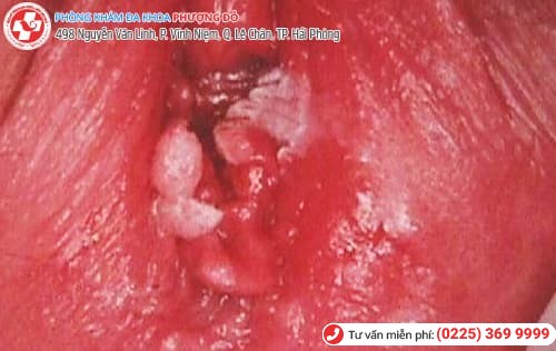 sùi mào gà ở nữ