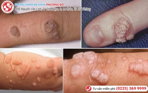 Sùi mào gà ở tay Sùi mào gà ở tay