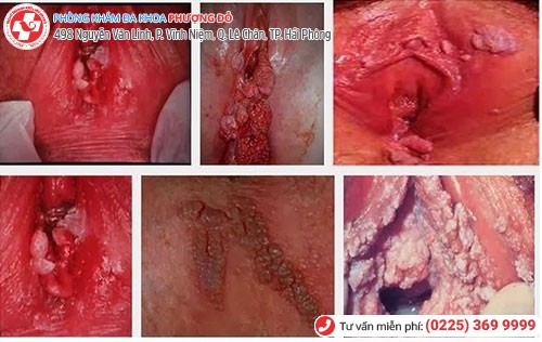 Hình ảnh mào gà ở vùng kín nữ Hình ảnh mào gà ở vùng kín nữ