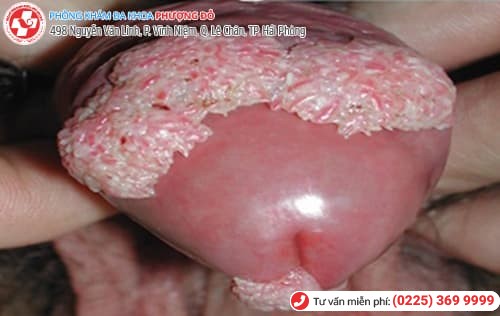 sùi mào gà thứ phát