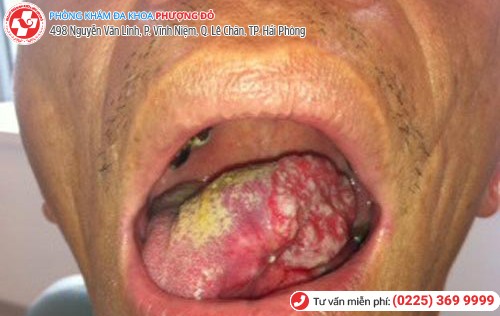 sùi mào gà ở lưỡi