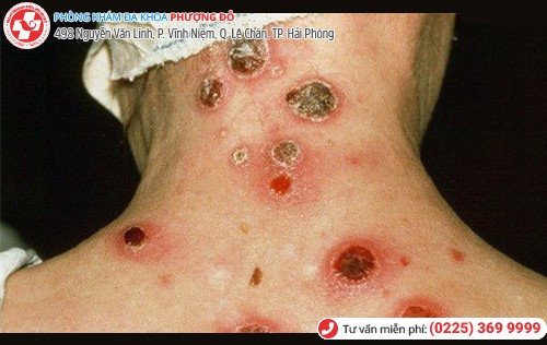 ảnh hưởng của bệnh giang mai ảnh hưởng của bệnh giang mai