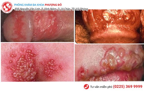 Mụn rộp gây nhiều biến chứng ở cơ quan sinh dục Mụn rộp gây nhiều biến chứng ở cơ quan sinh dục
