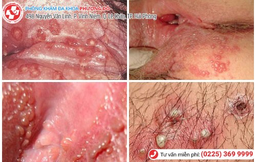 Mụn rộp sinh dục ảnh hưởng trực tiếp đến cơ quan sinh dục Mụn rộp sinh dục ảnh hưởng trực tiếp đến cơ quan sinh dục