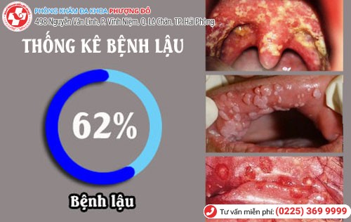 Bệnh lậu chiếm tỷ lệ thống kê cao Thống kê bệnh lậu