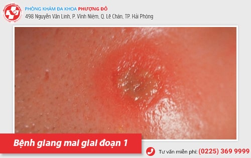 Thuốc điều trị bệnh giang mai có những loại nào? Hiệu quả ra sao?