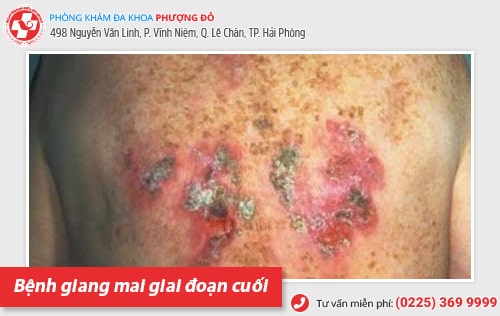 Thuốc điều trị bệnh giang mai có những loại nào? Hiệu quả ra sao?