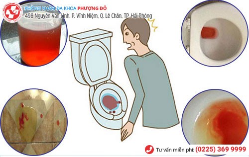 Tiểu buốt ra máu ở nam nữ do nhiều nguyên nhân gây nên Tiểu buốt ra máu ở nam nữ do nhiều nguyên nhân gây nên