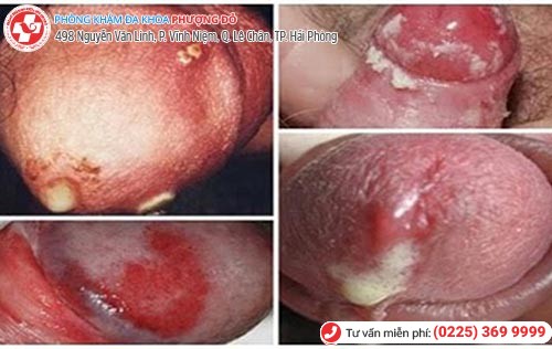 Hình ảnh bệnh lậu ở cơ quan sinh dục nam Hình ảnh bệnh lậu ở cơ quan sinh dục nam
