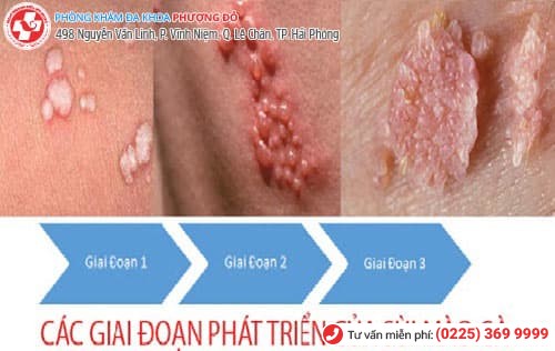 triệu chứng bệnh sùi mào gà triệu chứng bệnh sùi mào gà