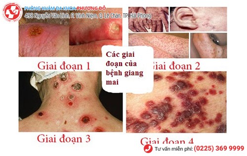 Các giai đoạn bệnh giang mai ở nam giới Các giai đoạn bệnh giang mai ở nam giới