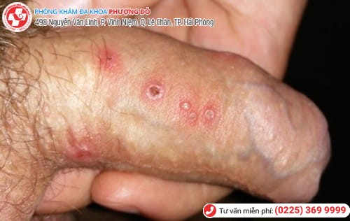 triệu chứng mụn rộp sinh dục nam triệu chứng mụn rộp sinh dục nam