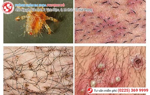 biểu hiện bệnh rận mu