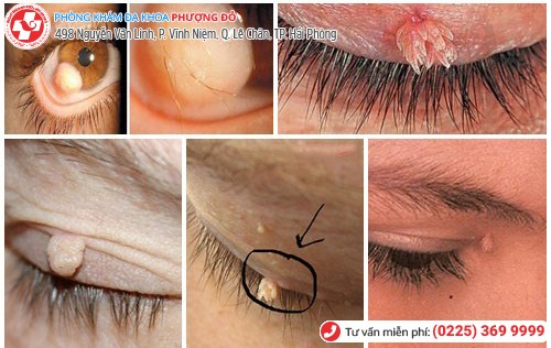 triệu chứng sùi mào gà ở mắt