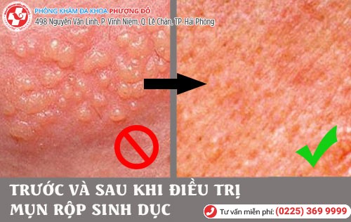 Trước và sau khi hỗ trợ điều trị mụn rộp sinh dục Kết quả sau khi hỗ trợ điều trị mụn rộp sinh dục