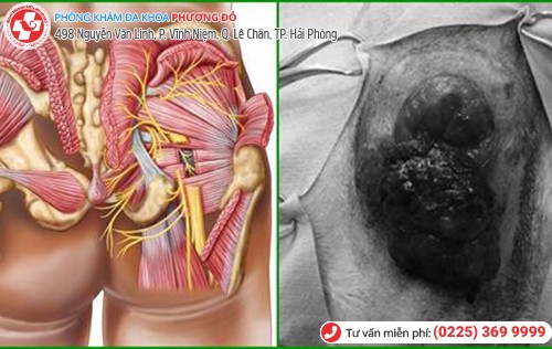 biến chứng sùi mào gà hậu môn