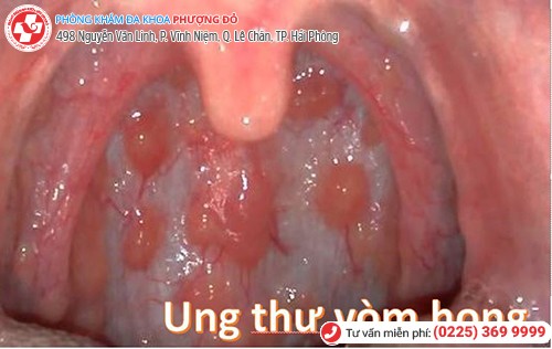 biến chứng sùi mào gà ở miệng