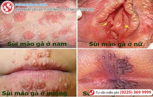 vị trí sùi mào gà vị trí sùi mào gà