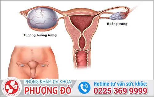  U nang buồng trứng